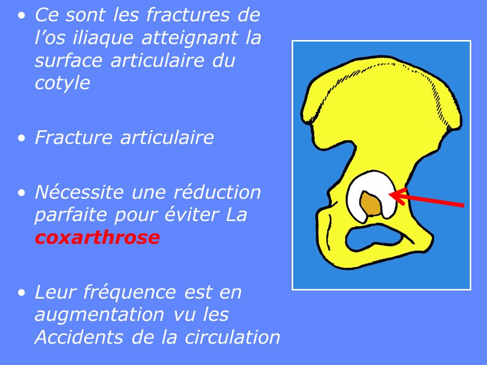 Fractures Du Cotyle Ou Fractures De Lac Tabulum Ppt Video Online